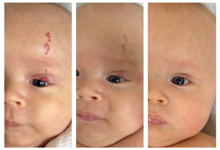 Hemangiomas Dermatologia En Lima Dermatologos En Lima Peru Tratamientos Laser Antiacne En 